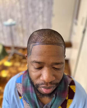 Before hair transplant result