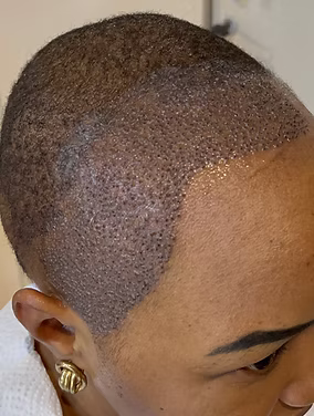 Before hair restoration client