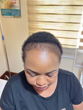 After hair restoration client