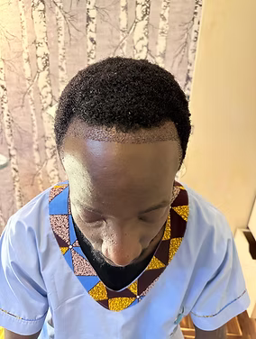 Before male hair transplant