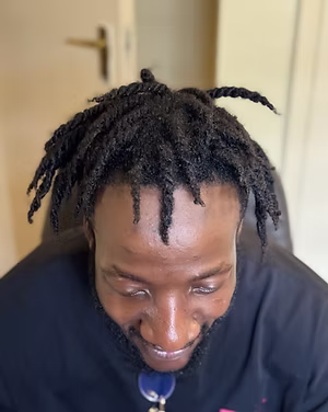 After male hair transplant