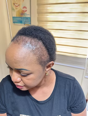 Before hairline restoration